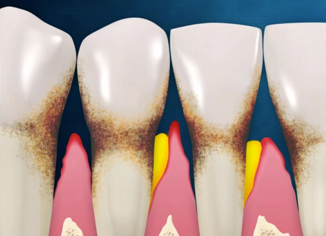 Wortwolke in Form einer Zahnpastatube mit Begriffen wie Kaliumnitrat, Anti-Gingivitis und Karies-Schutz.