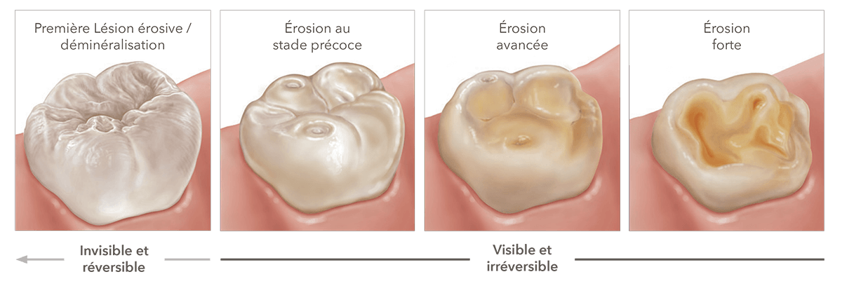 Graphique de l'érosion dentaire