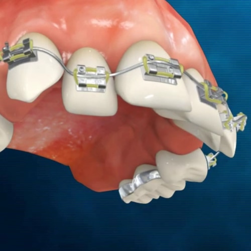 Nuage de mots en forme de tube de dentifrice mettant l'accent sur « nitrate de potassium », avec des termes tels que « anti-gingivite », « anti-caries » et « dentifrice »