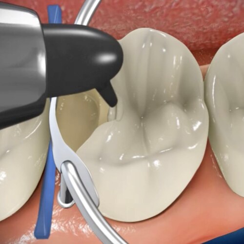Nuage de mots en forme de tube de dentifrice, mettant l'accent sur « nitrate de potassium », avec des termes tels que « anti-gingivite », « anti-caries » et « dentifrice »