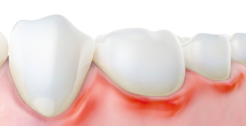 Gingivitis / Parodontitis Gingivitis / Parodontitis