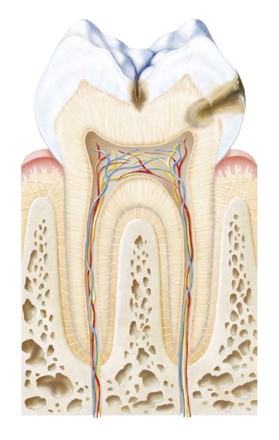 gestion des caries gestion des caries