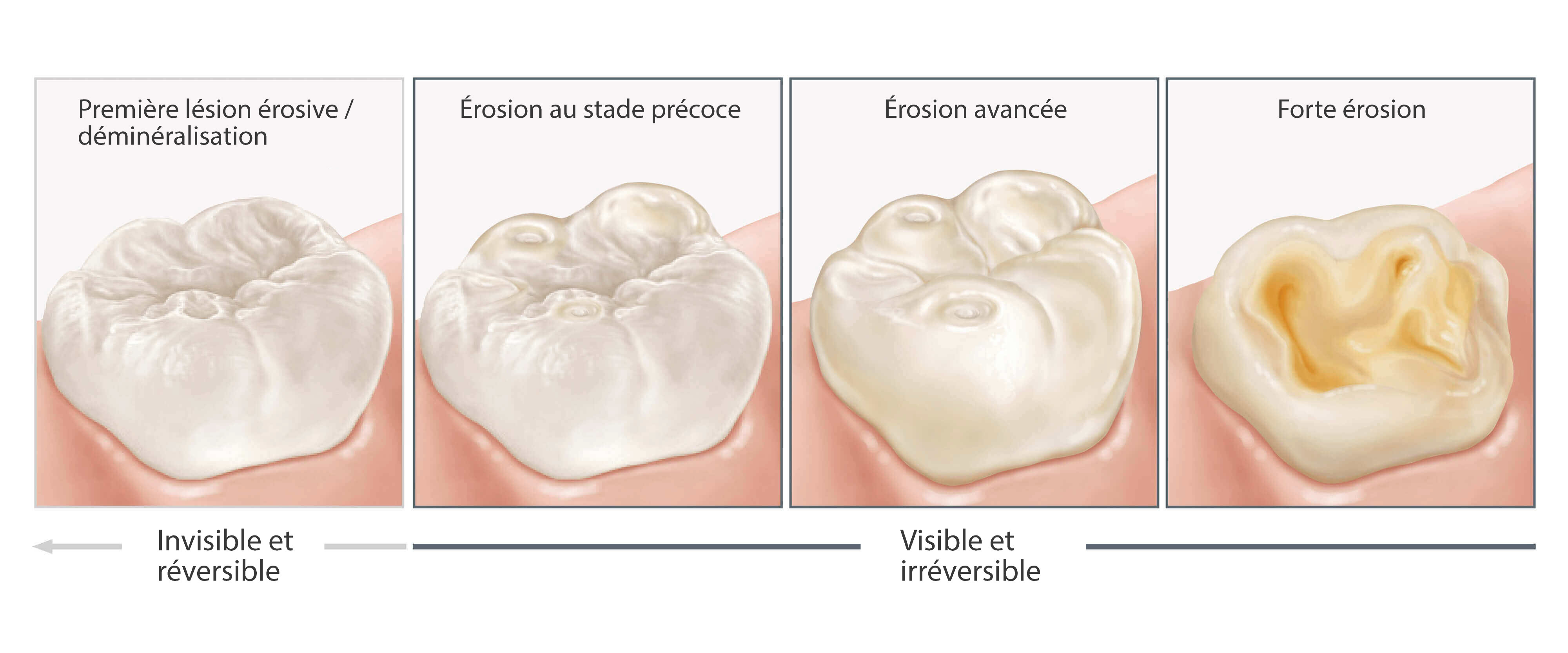 Première lésion érosive / déminéralisation