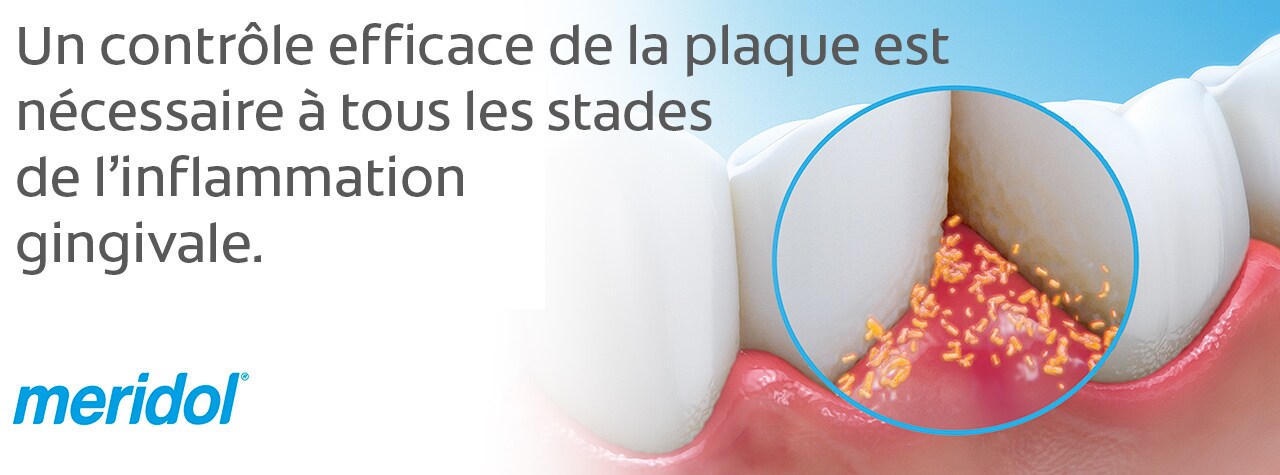Un contrôle efficace de la plaque est nécessaire à tous les stades de l’inflammation gingivale.