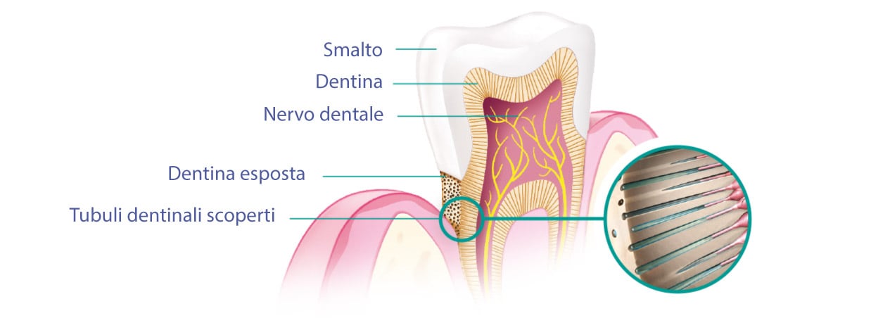 Ipersensibilità dentinale
